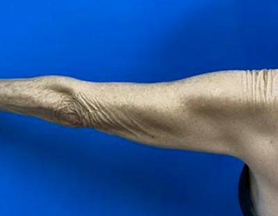 Arm Lift Before & After Gallery - Patient 249913 - Image 1