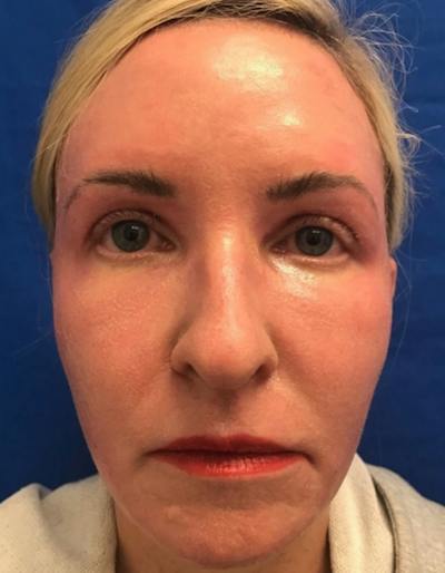 Laser Resurfacing Before & After Gallery - Patient 607416 - Image 2