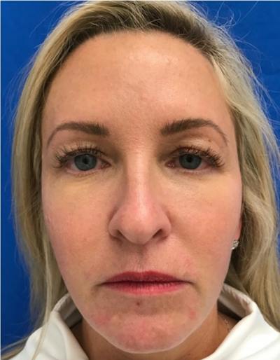 Laser Resurfacing Before & After Gallery - Patient 607416 - Image 1