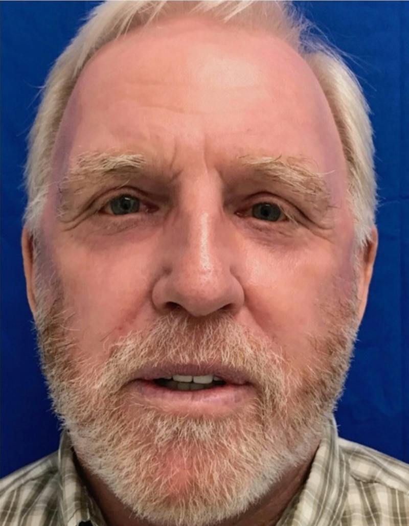 Laser Resurfacing Before & After Gallery - Patient 220437 - Image 2
