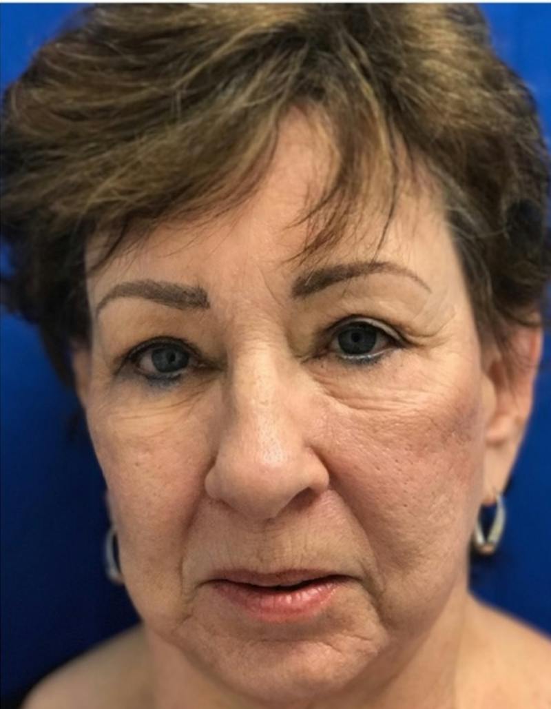 Laser Resurfacing Before & After Gallery - Patient 114311 - Image 1