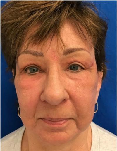 Laser Resurfacing Before & After Gallery - Patient 114311 - Image 2