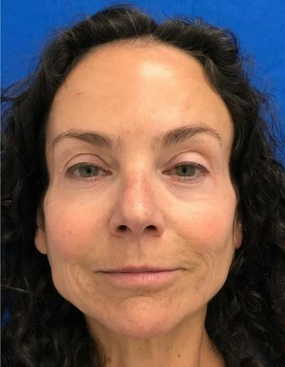 Laser Resurfacing Before & After Gallery - Patient 213208 - Image 1