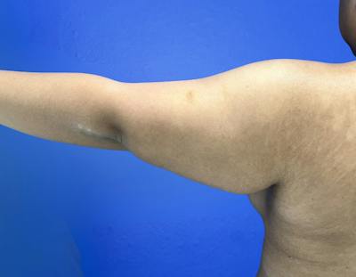 Arm Lift Before & After Gallery - Patient 269079 - Image 1