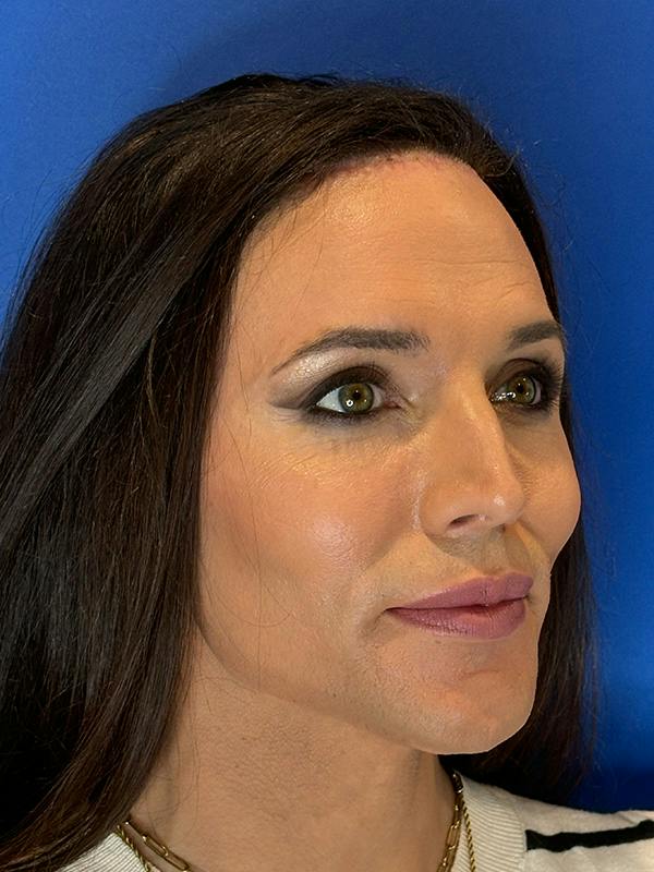 Forehead Reduction Before & After Gallery - Patient 374578 - Image 4