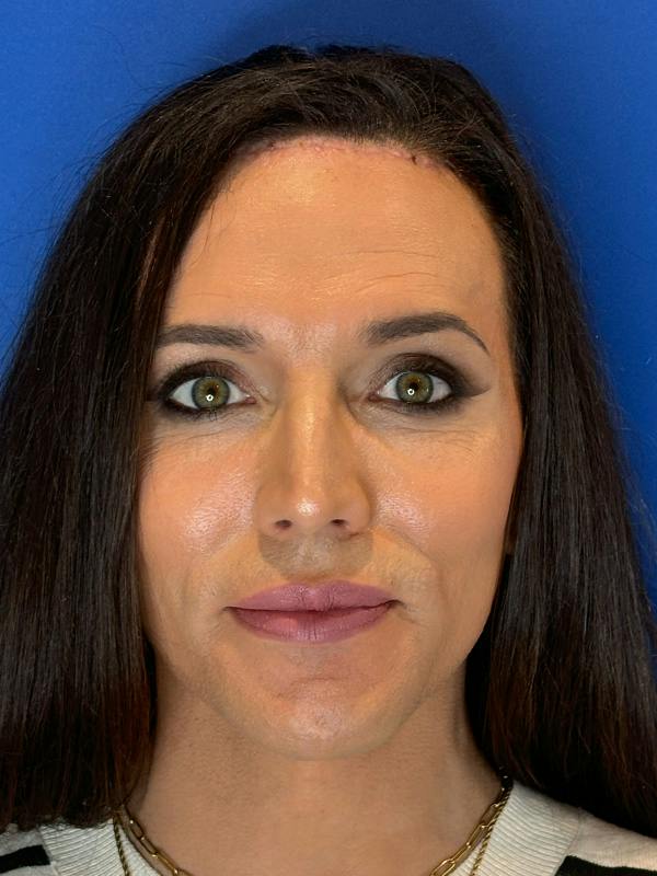 Forehead Reduction Before & After Gallery - Patient 374578 - Image 2