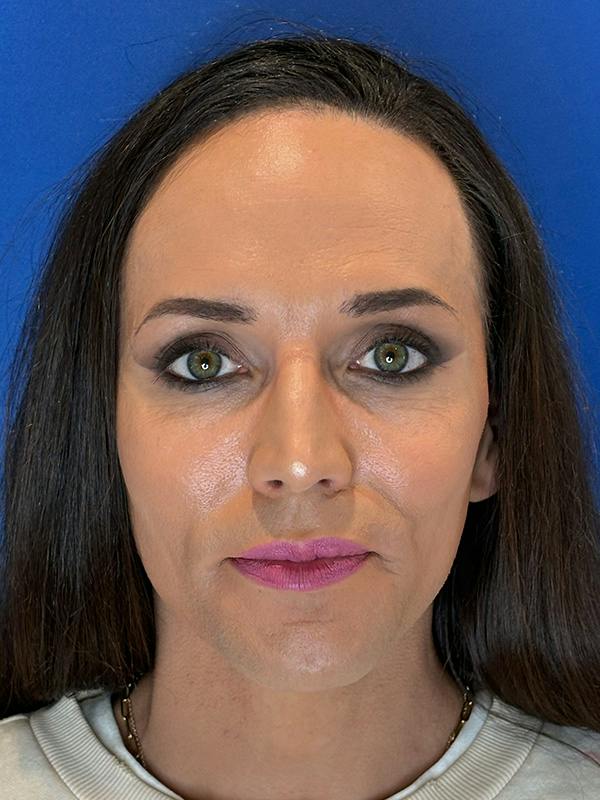 Forehead Reduction Before & After Gallery - Patient 374578 - Image 1