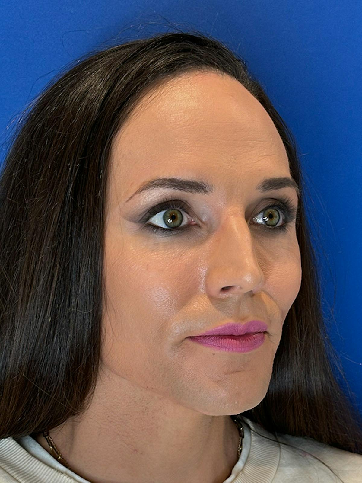 Forehead Reduction Before & After Gallery - Patient 374578 - Image 3