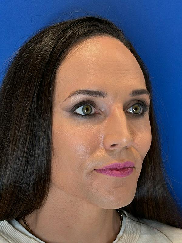 Forehead Reduction Before & After Gallery - Patient 374578 - Image 3