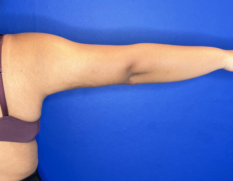 Arm Lift Before & After Gallery - Patient 269079 - Image 4
