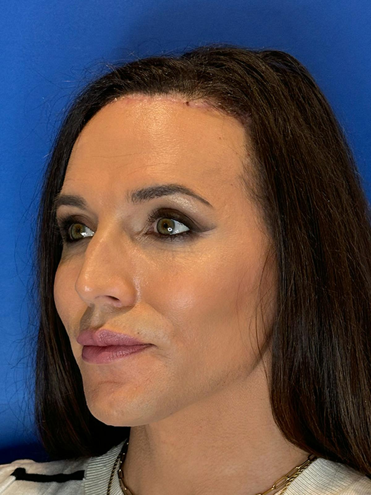 Forehead Reduction Before & After Gallery - Patient 374578 - Image 8