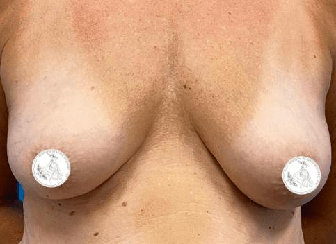 Breast Augmentation Before & After Gallery - Patient 416703 - Image 1