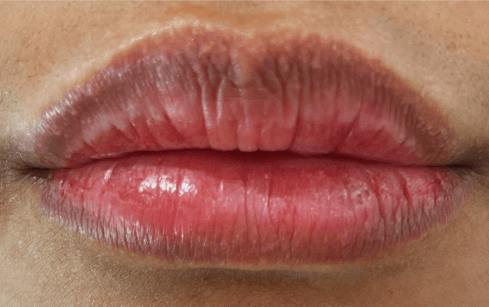 Lip Filler Before & After Gallery - Patient 999427 - Image 2