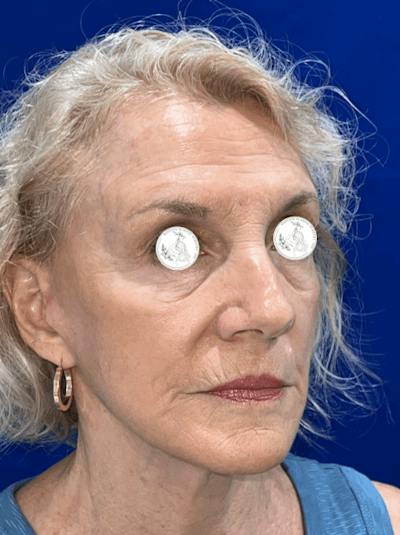 Face Lift Before & After Gallery - Patient 306856 - Image 2