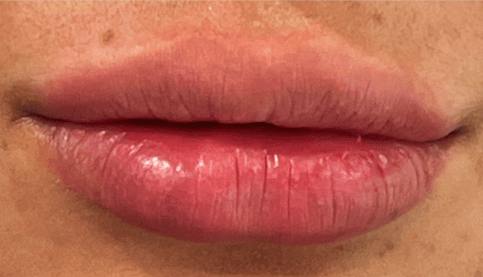 Lip Filler Before & After Gallery - Patient 100083 - Image 2