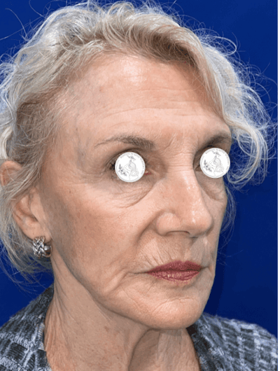 Face Lift Before & After Gallery - Patient 306856 - Image 1