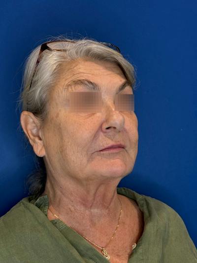 Face Lift Before & After Gallery - Patient 246199 - Image 1