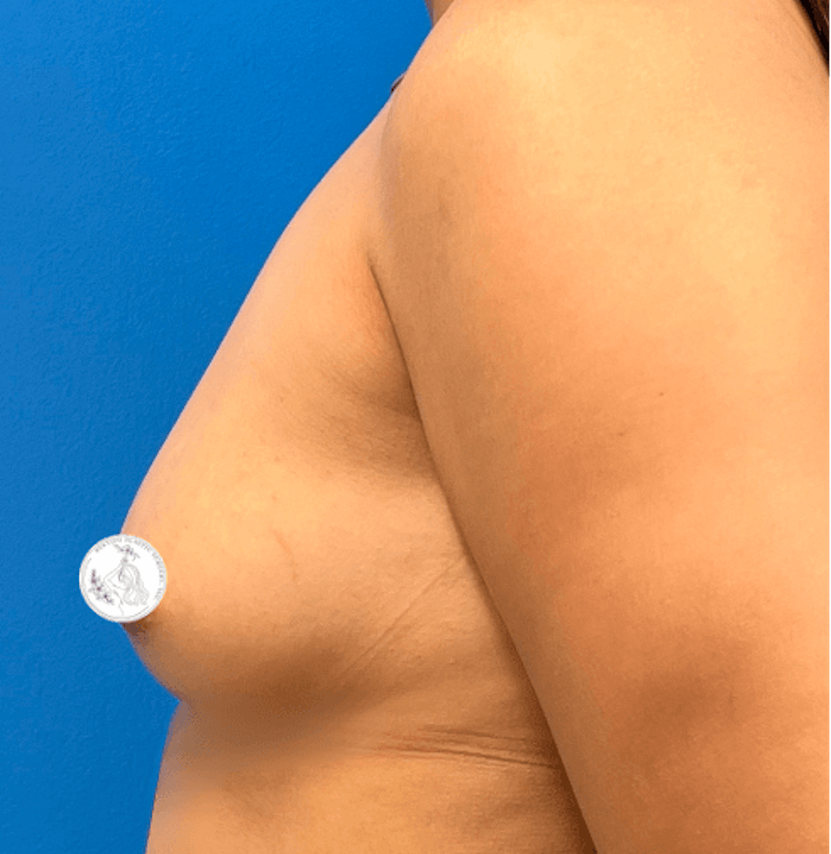 Breast Augmentation Before & After Gallery - Patient 907468 - Image 1
