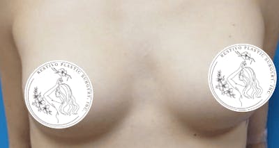 Breast Augmentation Before & After Gallery - Patient 564814 - Image 1