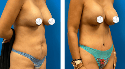 Abdominoplasty Before & After Gallery - Patient 334637 - Image 1