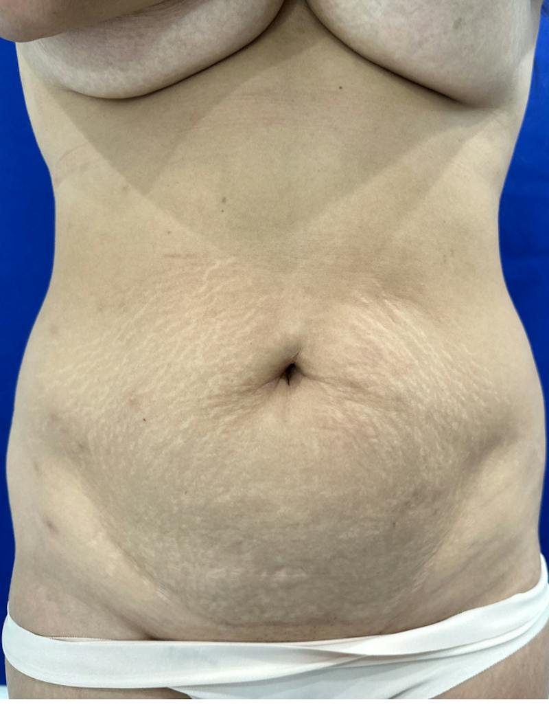 Tummy Tuck Before & After Gallery - Patient 165709 - Image 1