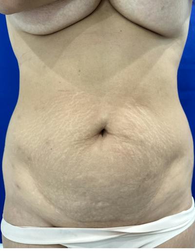 Tummy Tuck Before & After Gallery - Patient 165709 - Image 1