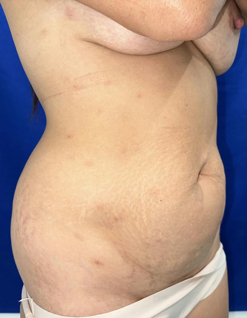 Tummy Tuck Before & After Gallery - Patient 165709 - Image 5