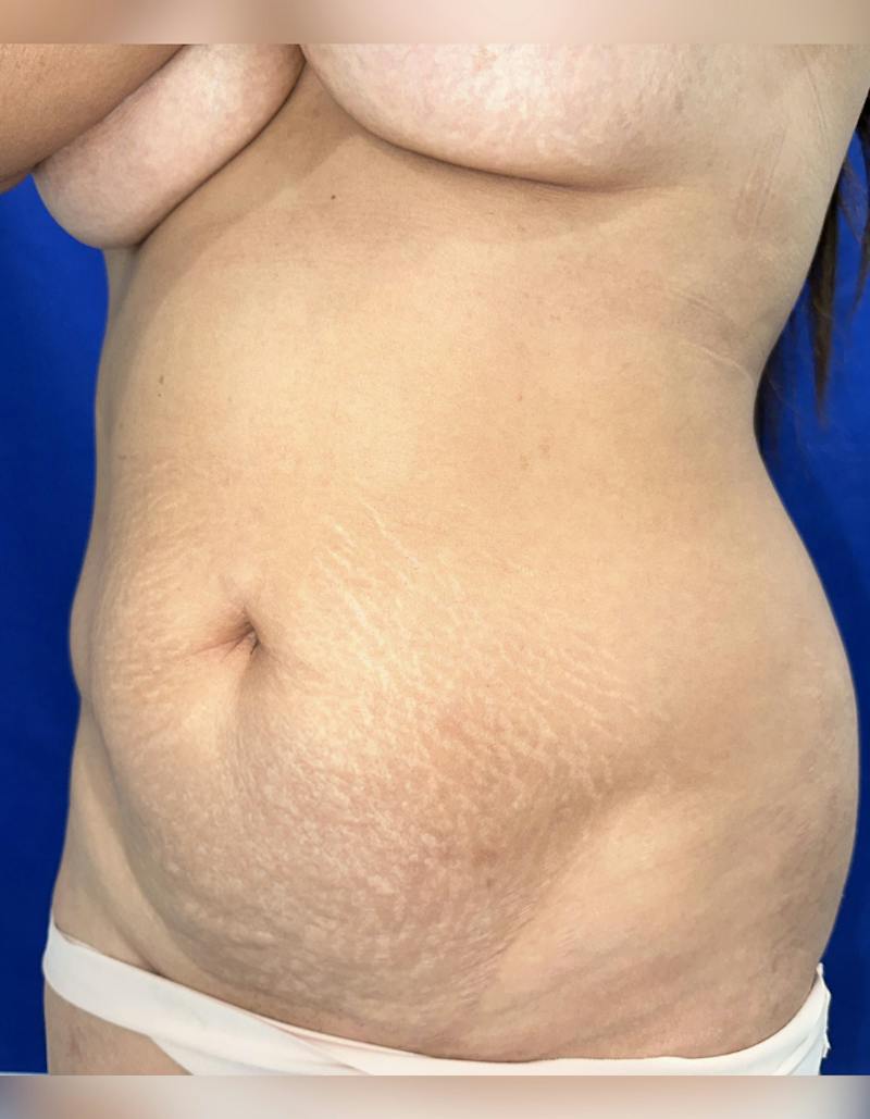 Tummy Tuck Before & After Gallery - Patient 165709 - Image 3