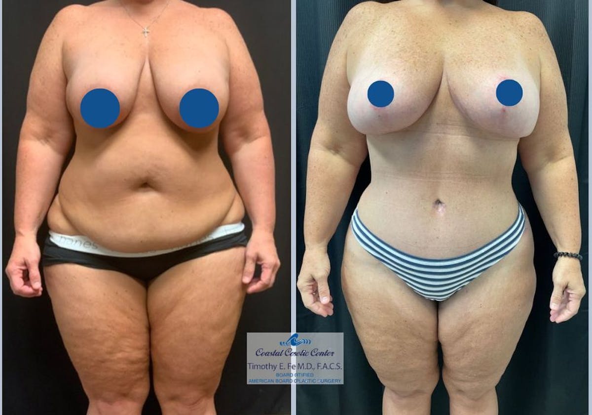 Mommy Makeover Before & After Gallery - Patient 103873 - Image 1