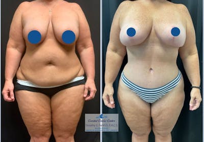 Mommy Makeover Before & After Gallery - Patient 103873 - Image 1