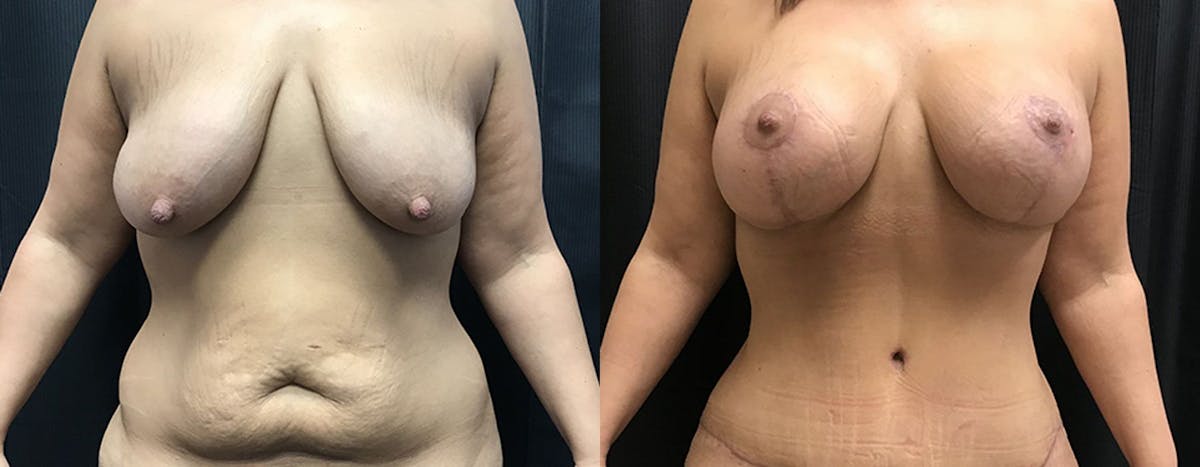 Mommy Makeover Before & After Gallery - Patient 100612 - Image 1