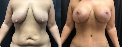 Mommy Makeover Before & After Gallery - Patient 100612 - Image 1