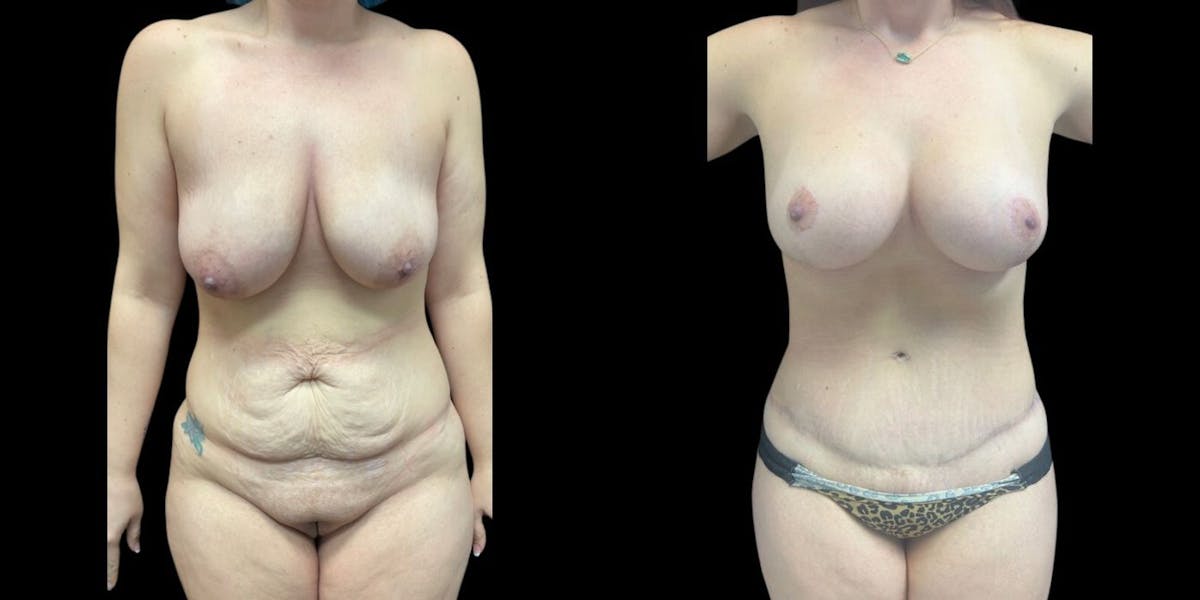 Mommy Makeover Before & After Gallery - Patient 175310 - Image 1