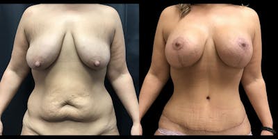 Mommy Makeover Before & After Gallery - Patient 272504 - Image 1