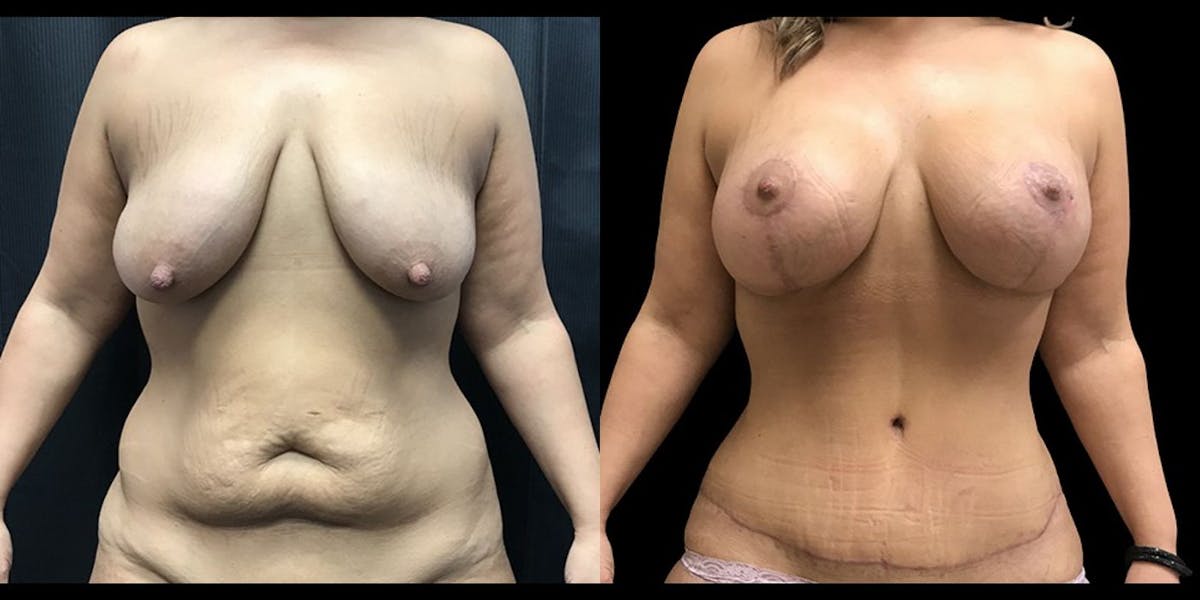 Mommy Makeover Before & After Gallery - Patient 272504 - Image 1