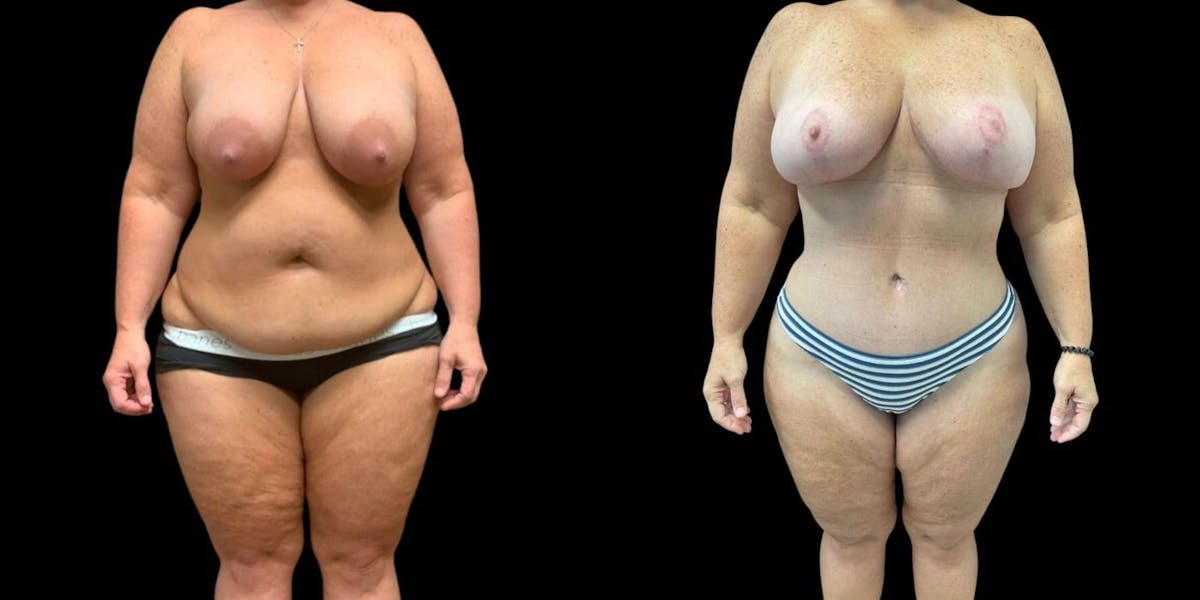 Mommy Makeover Before & After Gallery - Patient 210260 - Image 1