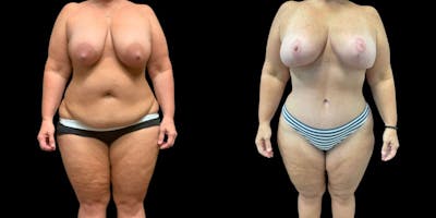 Mommy Makeover Before & After Gallery - Patient 210260 - Image 1