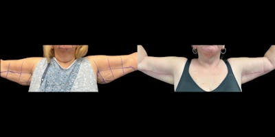 Arm Lift Before & After Gallery - Patient 183516 - Image 1