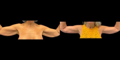 Arm Lift Before & After Gallery - Patient 184106 - Image 1