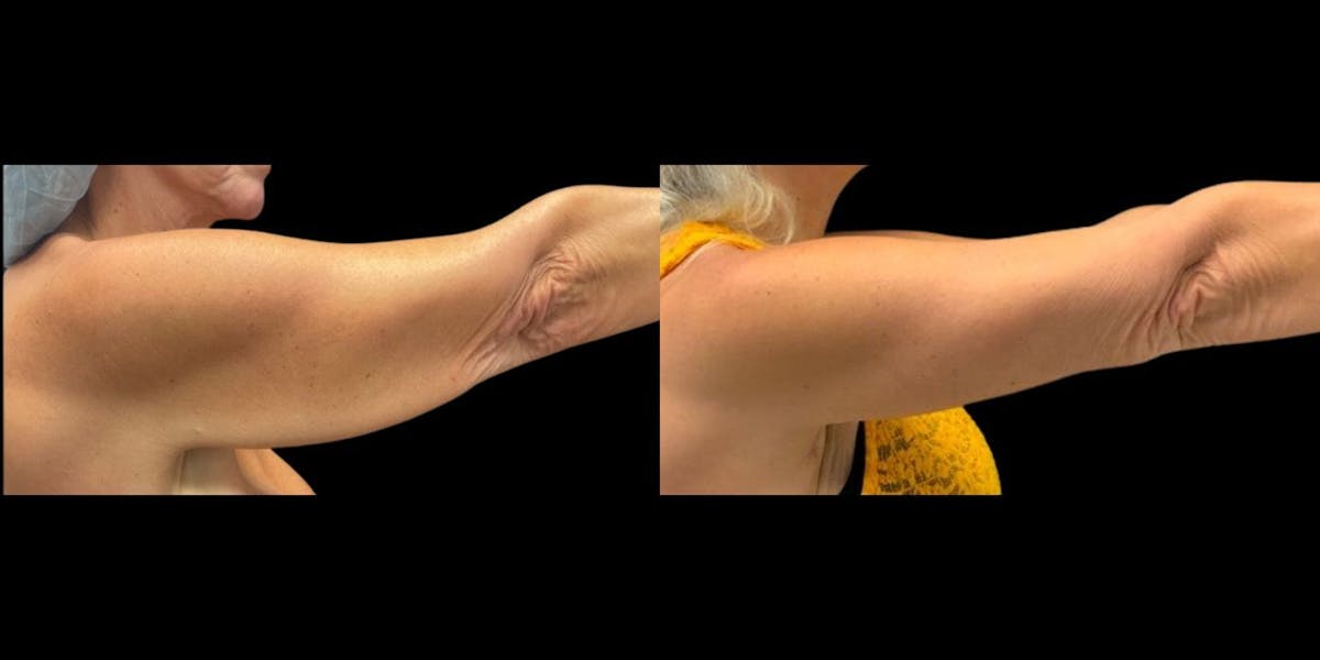 Arm Lift Before & After Gallery - Patient 718469 - Image 1