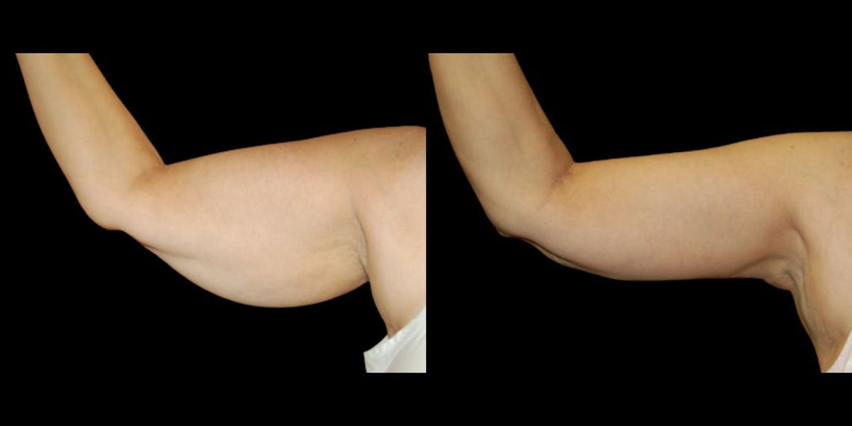 Arm Lift Before & After Gallery - Patient 361184 - Image 1