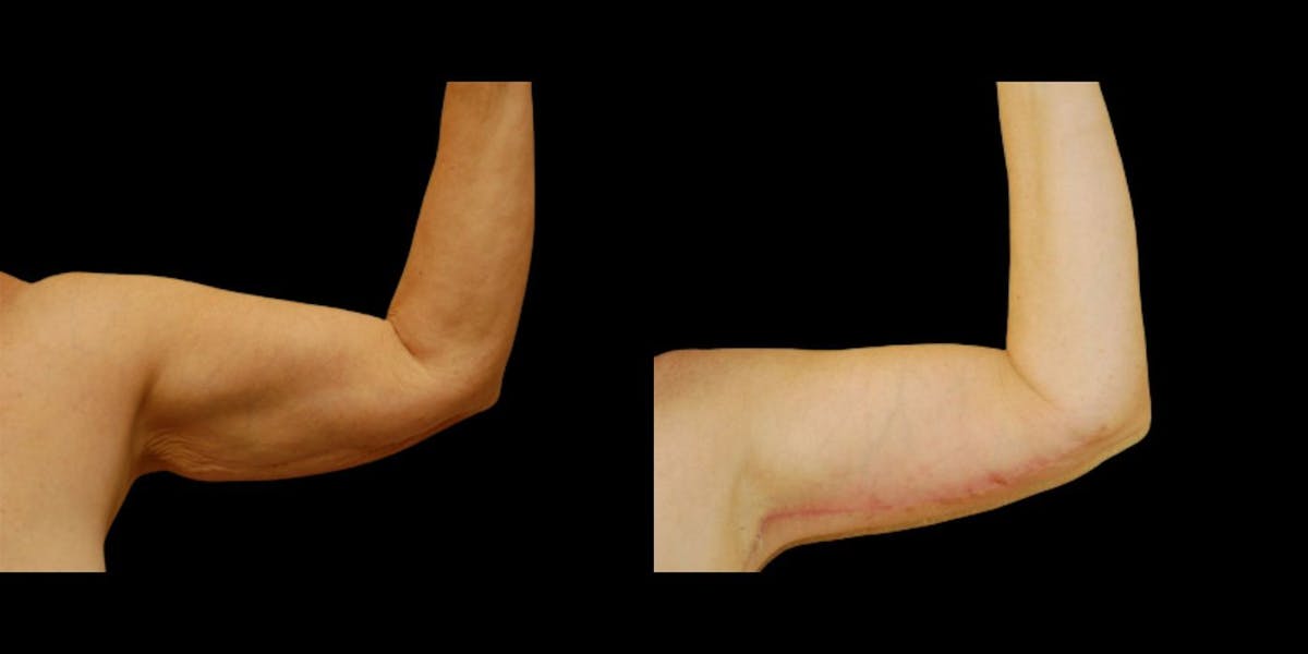 Arm Lift Before & After Gallery - Patient 916483 - Image 1