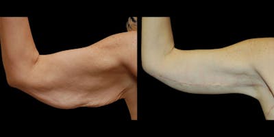 Arm Lift Before & After Gallery - Patient 571125 - Image 1