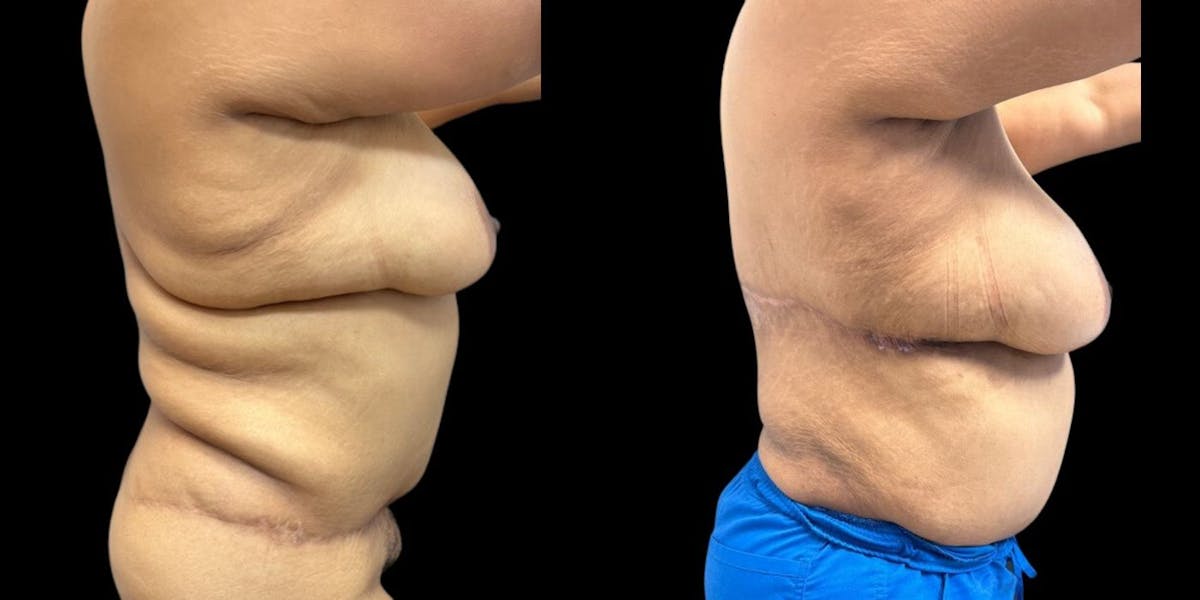 Body Lift Before & After Gallery - Patient 354731 - Image 1