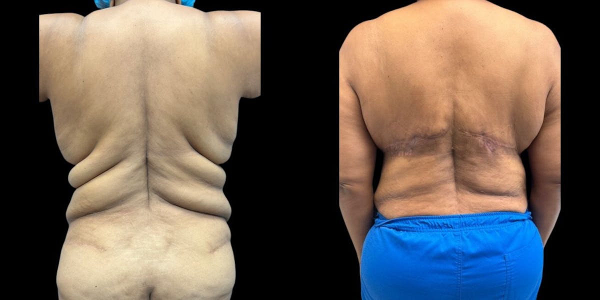 Body Lift Before & After Gallery - Patient 116576 - Image 1