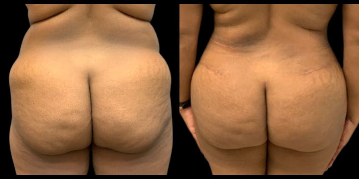 Brazilian Butt Lift Before & After Gallery - Patient 286127 - Image 1