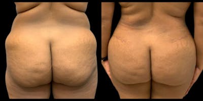 Brazilian Butt Lift Before & After Gallery - Patient 286127 - Image 1