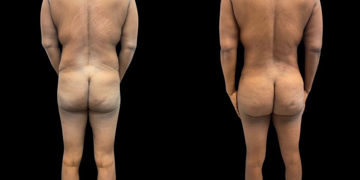 Brazilian Butt Lift Before & After Gallery - Patient 133405 - Image 1