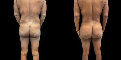 Brazilian Butt Lift Before & After Gallery - Patient 133405 - Image 1