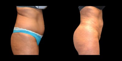 Liposuction Before & After Gallery - Patient 299608 - Image 1